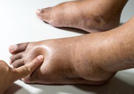 Luka Kaki Sulit Sembuh? Bisa Jadi Gejala Diabetes!