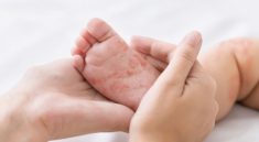 Kasus Suspek Campak Naik di Pohuwato, Banyak Anak Belum Imunisasi