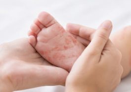 Kasus Suspek Campak Naik di Pohuwato, Banyak Anak Belum Imunisasi