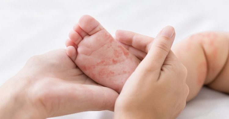 Kasus Suspek Campak Naik di Pohuwato, Banyak Anak Belum Imunisasi