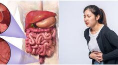 Kanker Usus Besar Meningkat di Usia Muda, Ini Faktornya