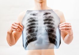 Deteksi Dini Kanker Paru Sebelum Muncul Gejala