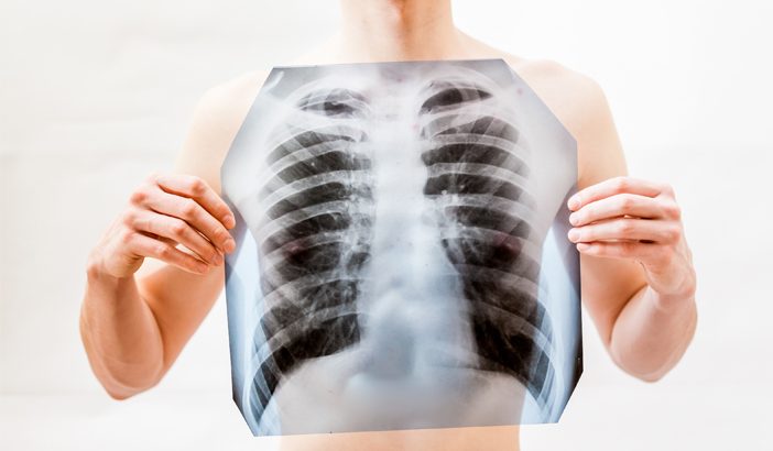 Deteksi Dini Kanker Paru Sebelum Muncul Gejala
