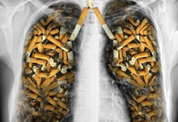 Jenis Rokok Tentukan Risiko dan Lokasi Kanker