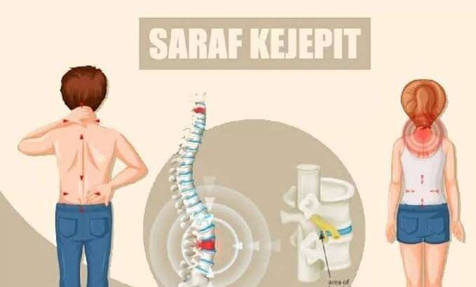 Saraf Terjepit Bisa Terjadi di Usia Muda, Cek Faktanya