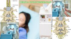 Kemoterapi Intratekal Cara Obati Kanker Otak & Tulang Belakang