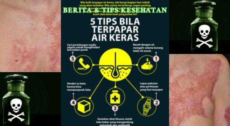 Luka Akibat Air Keras Cara Aman Tangani Terkena Siraman