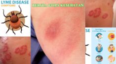 Penyakit Lyme Waspadai Dampak Jangka Panjangnya