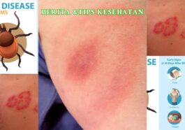 Penyakit Lyme Waspadai Dampak Jangka Panjangnya
