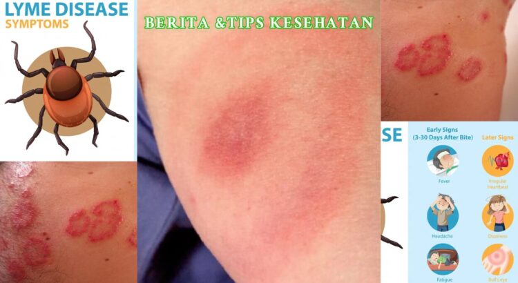 Penyakit Lyme Waspadai Dampak Jangka Panjangnya