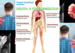 Waspada Sarkoma Kanker Langka yang Dapat Menyerang Remaja