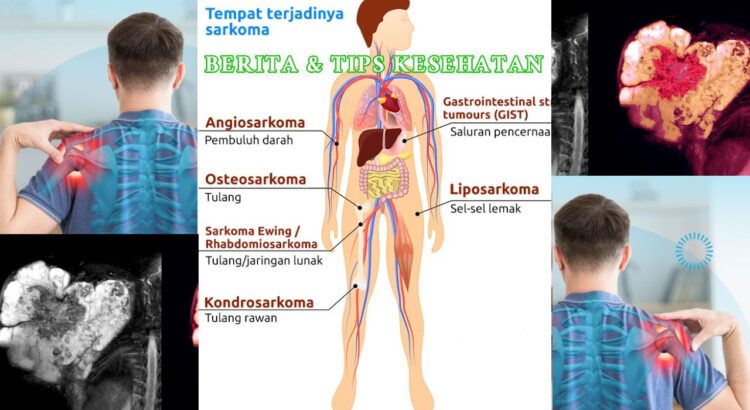 Waspada Sarkoma Kanker Langka yang Dapat Menyerang Remaja