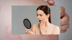 Gangguan Kulit Akibat Stres dan Cara Mengatasinya