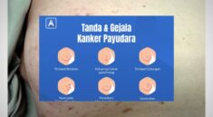 Gejala Awal Kanker Payudara yang Jarang Disadari