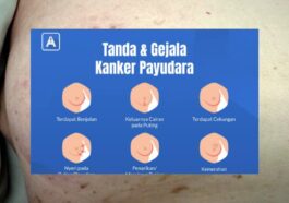 Gejala Awal Kanker Payudara yang Jarang Disadari
