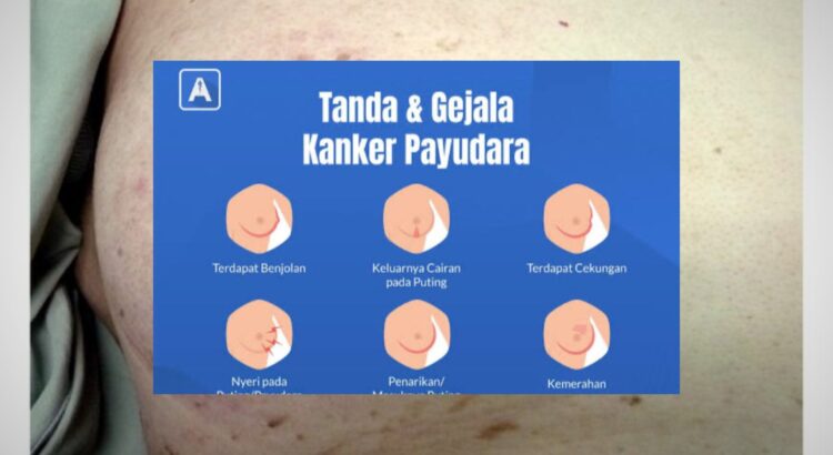 Gejala Awal Kanker Payudara yang Jarang Disadari