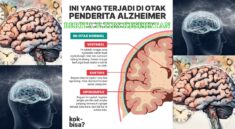 Waspadai Alzheimer Gangguan Otak Serius Bukan Sekadar Lupa