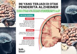Waspadai Alzheimer Gangguan Otak Serius Bukan Sekadar Lupa