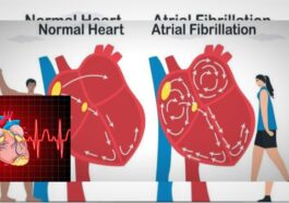 Awas! Fibrilasi Atrium Bisa Tingkatkan Risiko Stroke