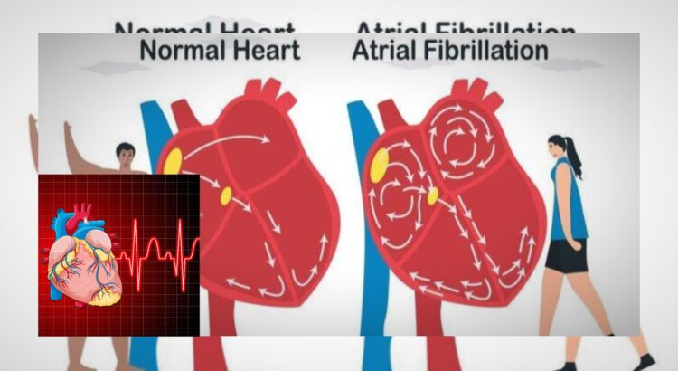 Awas! Fibrilasi Atrium Bisa Tingkatkan Risiko Stroke