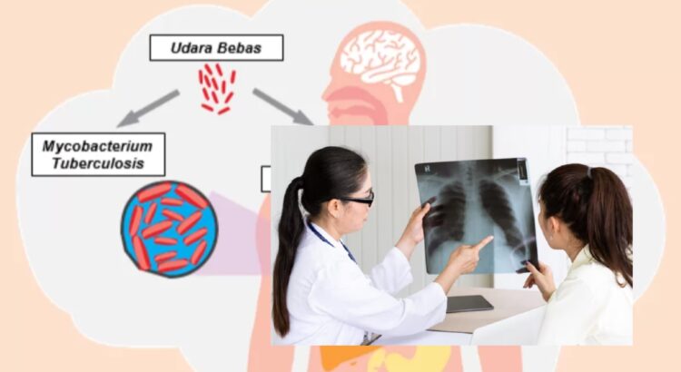 Penuntasan Kasus TBC Dukungan Kolaborasi Pusat dan Daera