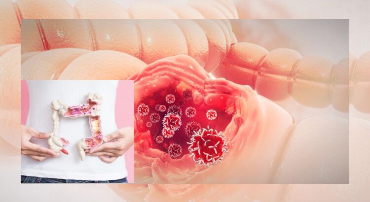 Kanker Kolorektal Serang Usia Muda, Ini Faktor Risikonya