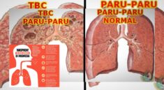 TBC Masih Mengancam Fakta Penting untuk Dipahami