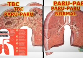 TBC Masih Mengancam Fakta Penting untuk Dipahami