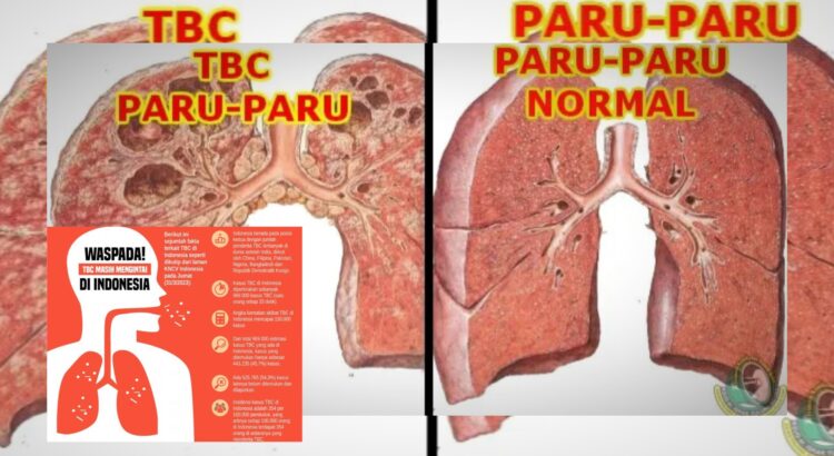 TBC Masih Mengancam Fakta Penting untuk Dipahami
