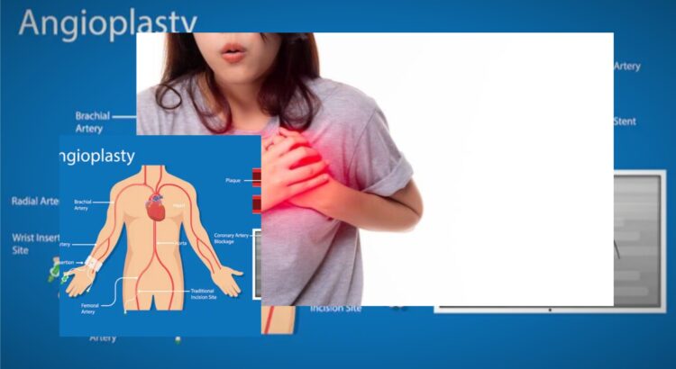 Tanda Serangan Jantung pada Perempuan yang Perlu Diwaspadai