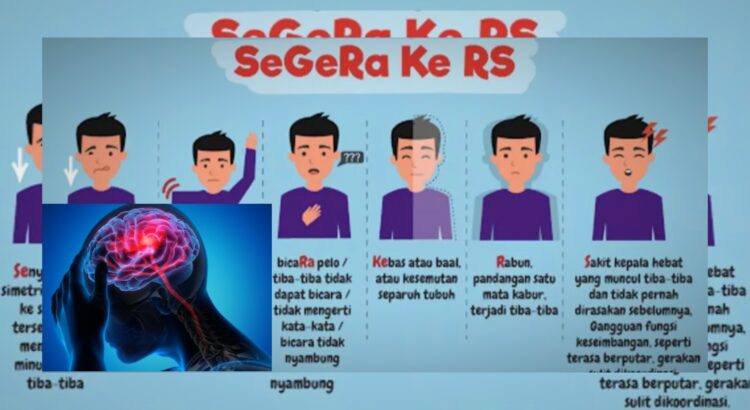 Waspadai Gejala Stroke yang Muncul Jauh Sebelum Serangan