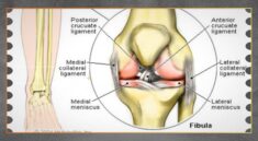 Ligamen Artifisial Jadi Solusi Baru Cedera Lutut