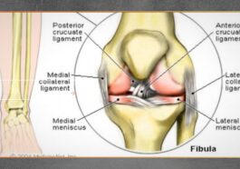 Ligamen Artifisial Jadi Solusi Baru Cedera Lutut