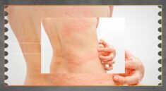 Gatal di Kulit Bisa Jadi Tanda Masalah Kesehatan