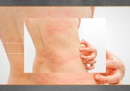 Gatal di Kulit Bisa Jadi Tanda Masalah Kesehatan