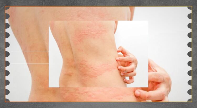 Gatal di Kulit Bisa Jadi Tanda Masalah Kesehatan