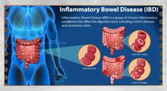 IBD, Penyakit Radang Usus Kronis yang Sering Terabaikan