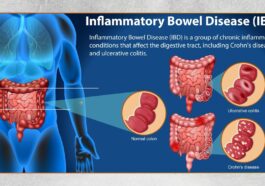 IBD, Penyakit Radang Usus Kronis yang Sering Terabaikan