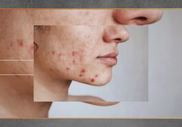 Jerawat di Dagu Penyebab Umum dan Cara Mencegahnya