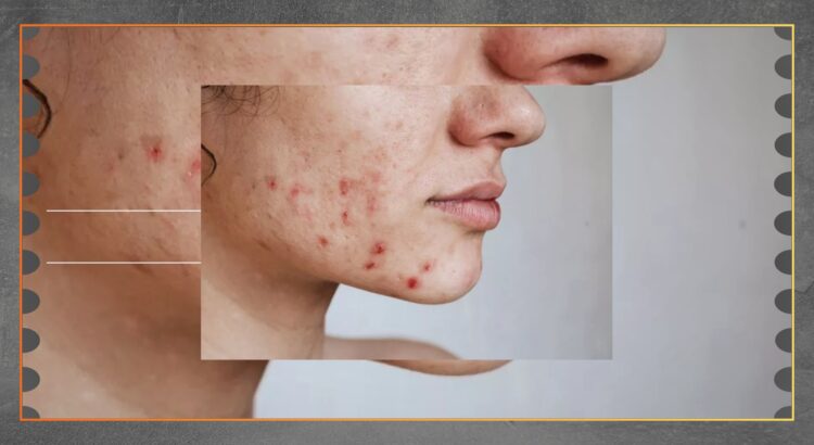 Jerawat di Dagu Penyebab Umum dan Cara Mencegahnya