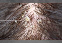 Ketombe Bisa Terkait Gangguan Kesehatan Tubuh