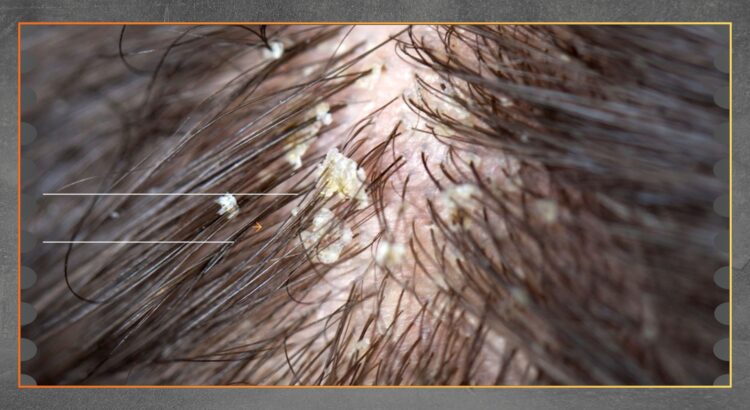 Ketombe Bisa Terkait Gangguan Kesehatan Tubuh