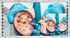 Mengenal TB Ginjal, Penyebab, Gejala, dan Deteksi Dini