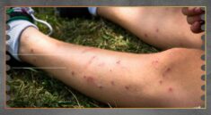 Penyebab Gatal Setelah Gigitan Serangga Menurut Medis