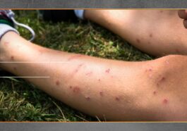 Penyebab Gatal Setelah Gigitan Serangga Menurut Medis