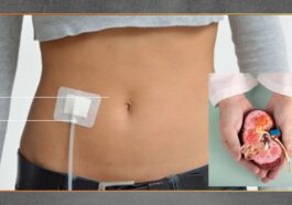 CAPD Alternatif Dialisis Mandiri bagi Pasien Gagal Ginjal