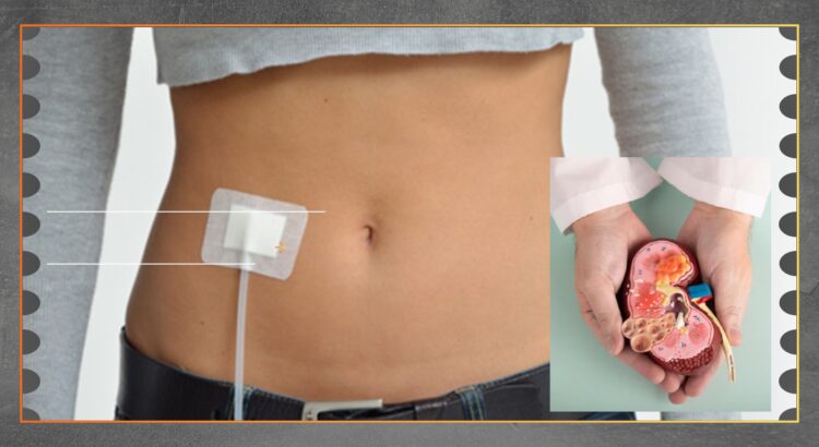 CAPD Alternatif Dialisis Mandiri bagi Pasien Gagal Ginjal