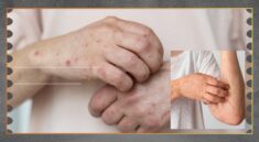 Lonjakan Campak 2026, Kemenkes Perkuat Respons