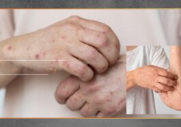 Lonjakan Campak 2026, Kemenkes Perkuat Respons