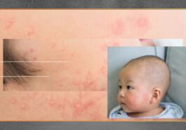 Ruam dan Diare Setelah Susu Waspadai Alergi Anak